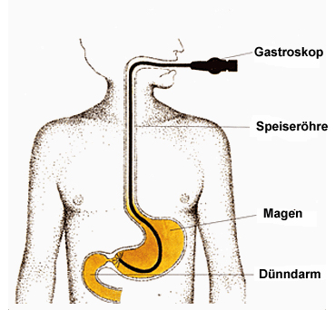 gastroscopy